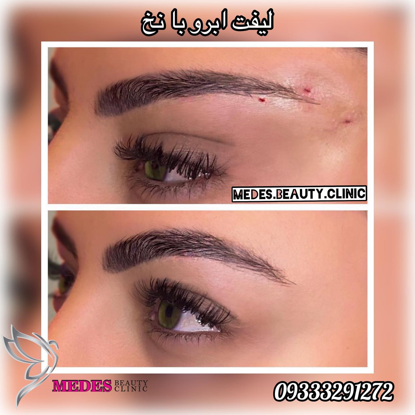 گالری لیفت با نخ